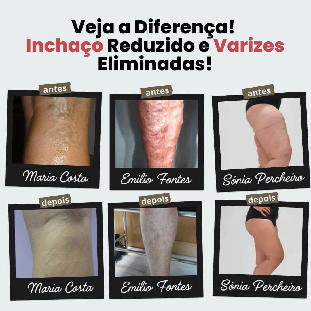 Meias de Acupressão Anti-Varizes